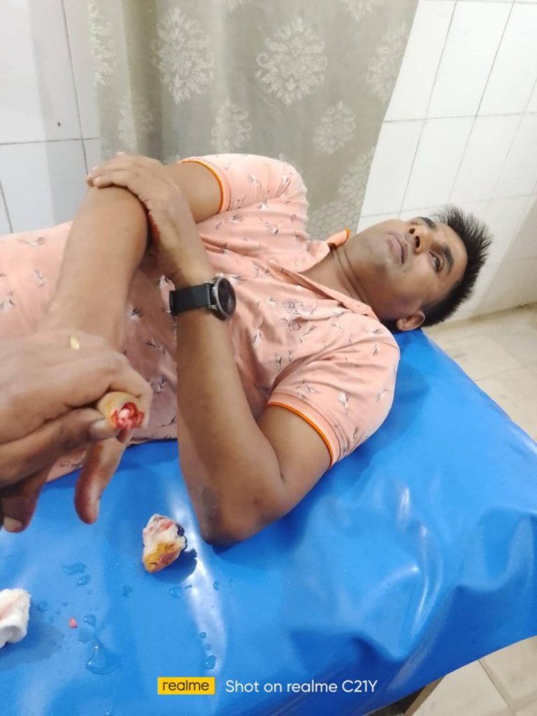বাউফলে বিট্রিশের কামড়ে অরুনের আঙুল বিচ্ছিন্ন!