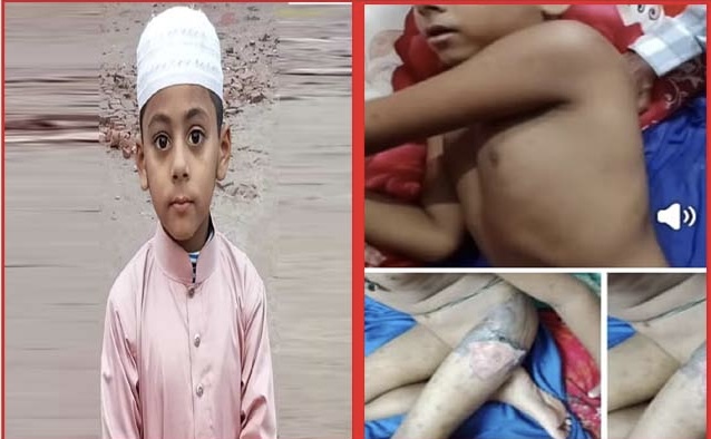 নগরীর কাশীপুর ইছাকাঠি কলোনীতে গরমপানি মেরে ঝলসে দিয়েছে শিশুর শরীর
