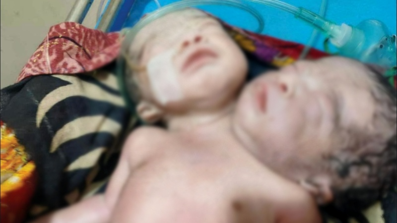 নেছারাবাদে দুই মাথা ও এক দেহবিশিষ্ট বিরল শিশুর জন্ম নেছারাবাদে দুই মাথা ও এক দেহবিশিষ্ট বিরল শিশুর জন্ম