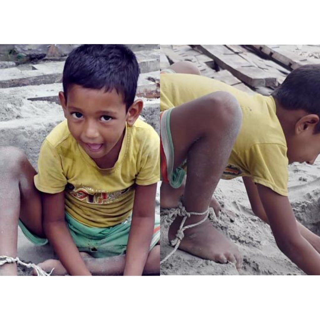 রাঙ্গাবালীতে চিকিৎসার অভাবে রশিতে বাঁধা ৭ বছরের জিসান